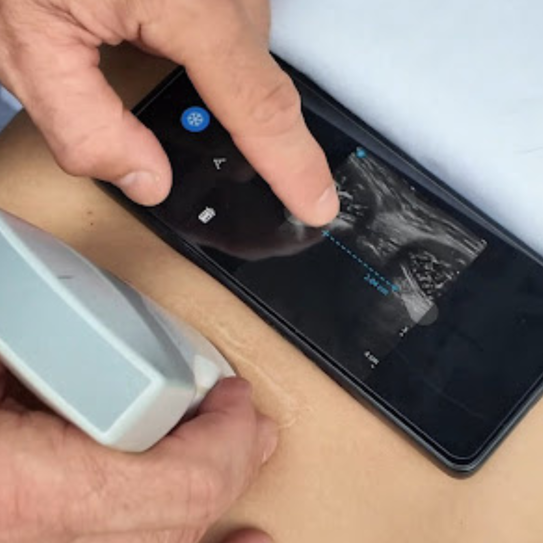 Ecografía en fisioterapia para valoración objetiva