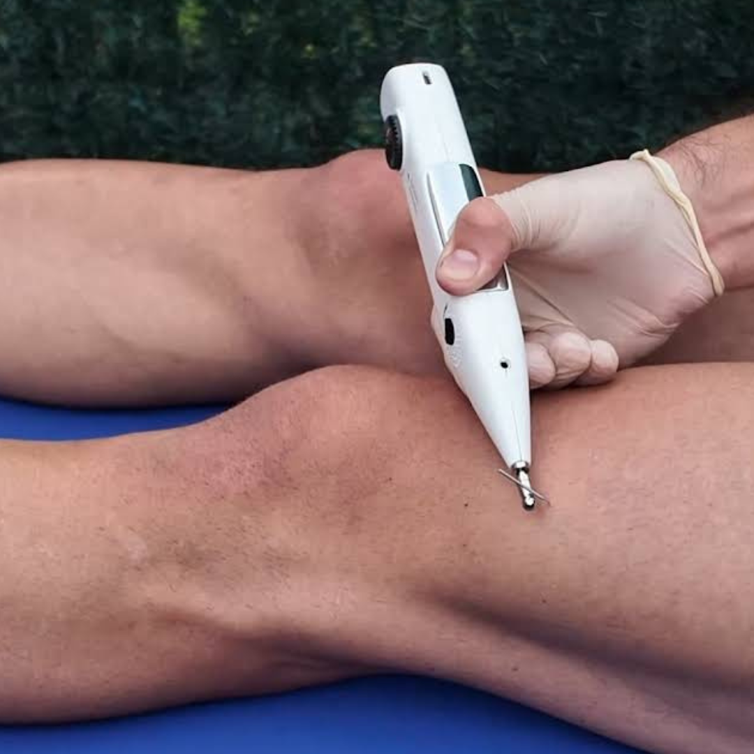 Electrósis EPTE aplicada fisioterapia en Sevilla